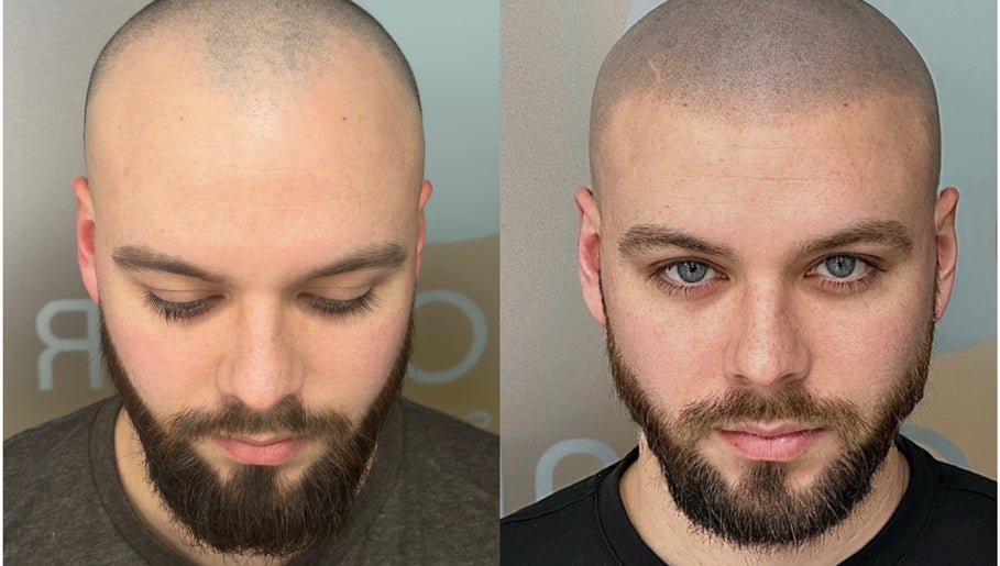 MicroHair® SMP Scalp Micropigmentation Hair Tattoo Clinic | Liverpool