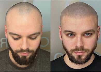 MicroHair® SMP Scalp Micropigmentation Hair Tattoo Clinic | Liverpool