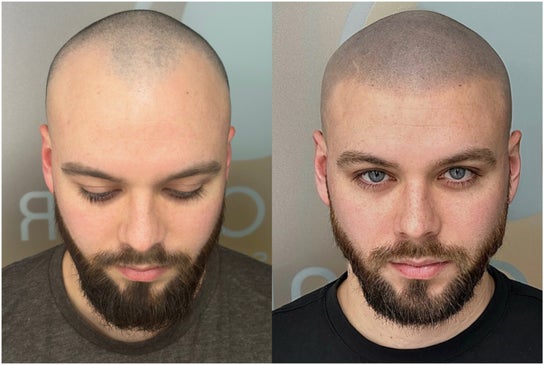 Hair Salon image for MicroHair® SMP Scalp Micropigmentation Hair Tattoo Clinic | Liverpool