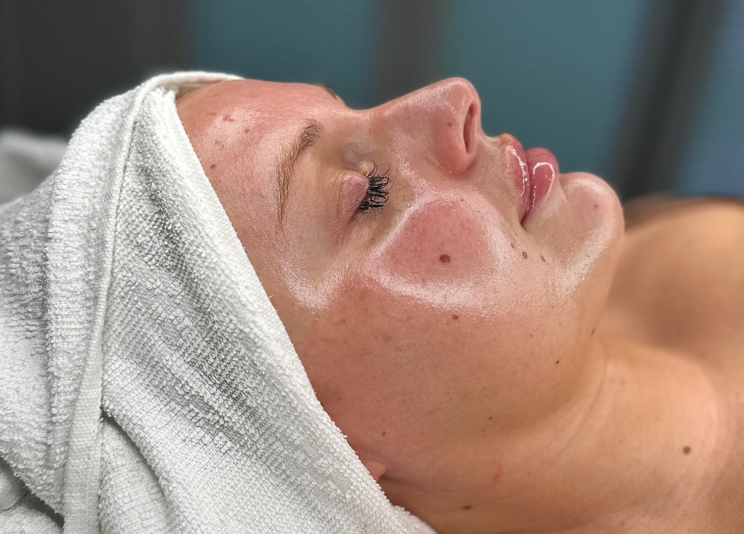 Facial treatment at Sknject in Rotherham, England. Woman's glowing skin after rejuvenating session.