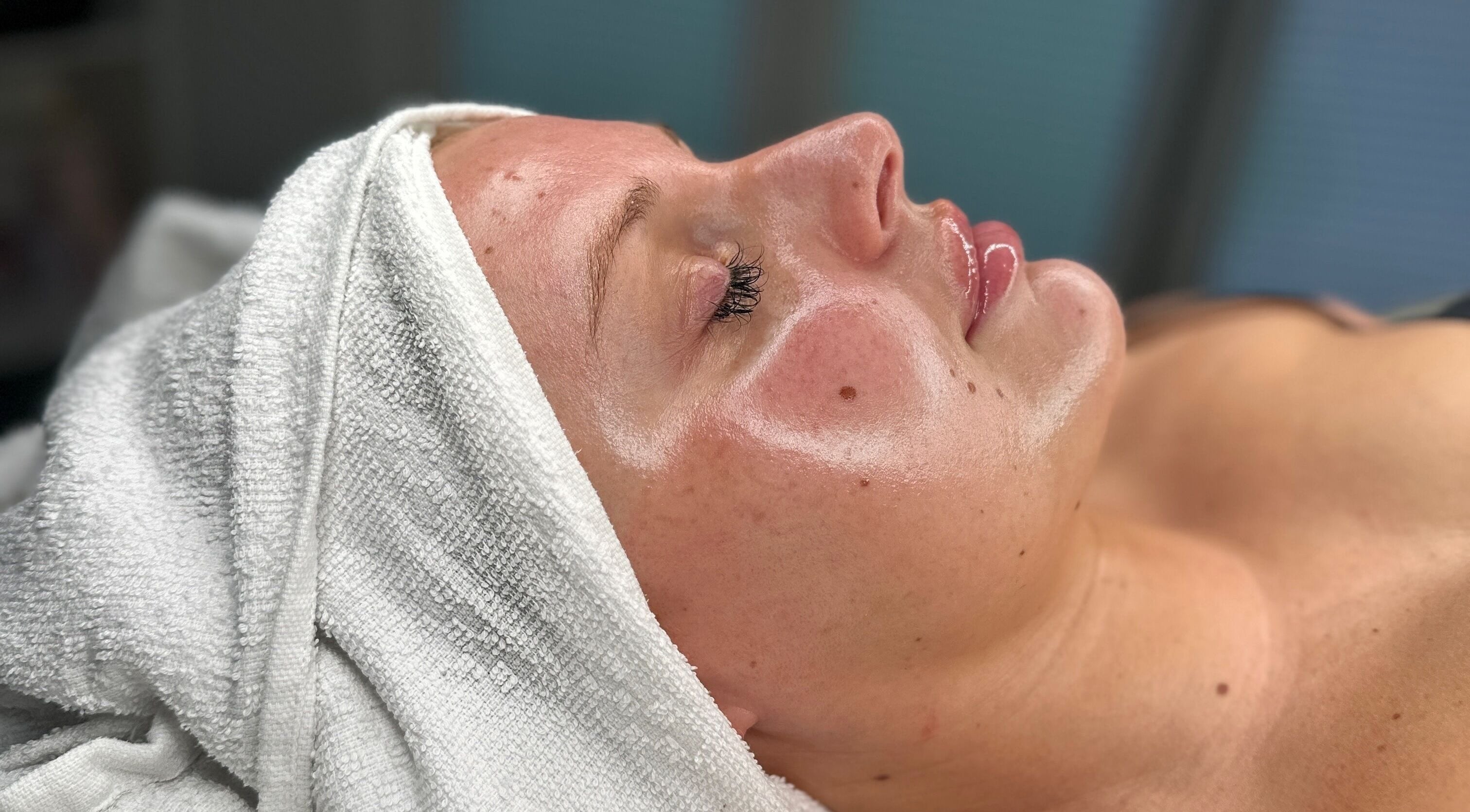 Facial treatment at Sknject in Rotherham, England. Woman's glowing skin after rejuvenating session.