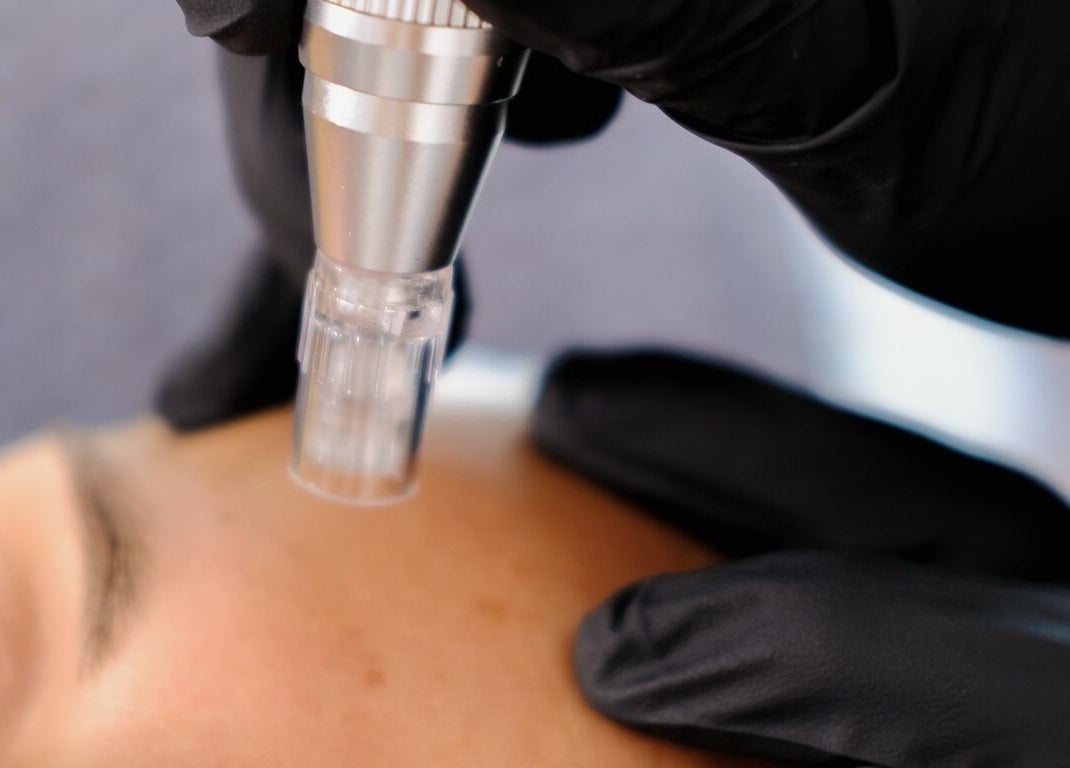 Close-up of a skin treatment at Skin Studio - Gainsborough, Gainsborough, England, GB showcasing facial care.