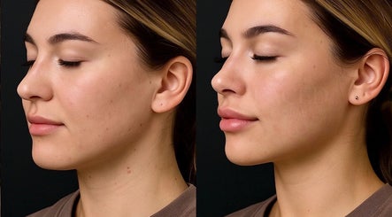 Before and after skin treatment at Faced Global, Manchester, England, GB, showcasing smooth glowing skin.