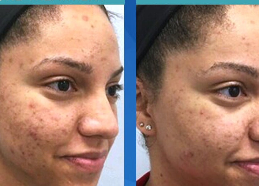 Before and after skin treatment at Lajori’s Beauty Bar and Spa, Stockbridge, Georgia, US.
