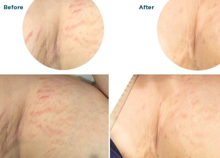 Before and after skin treatment at Lajori’s Beauty Bar and Spa, Stockbridge, Georgia, US showing improved texture.