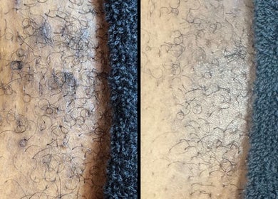 Before and after hair removal at Nightshade Esthetics LLC, San Diego, California, US.