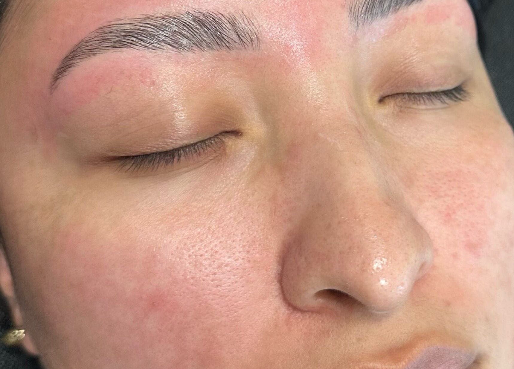 Client post-treatment with smooth skin at Nightshade Esthetics LLC, San Diego, California, US.