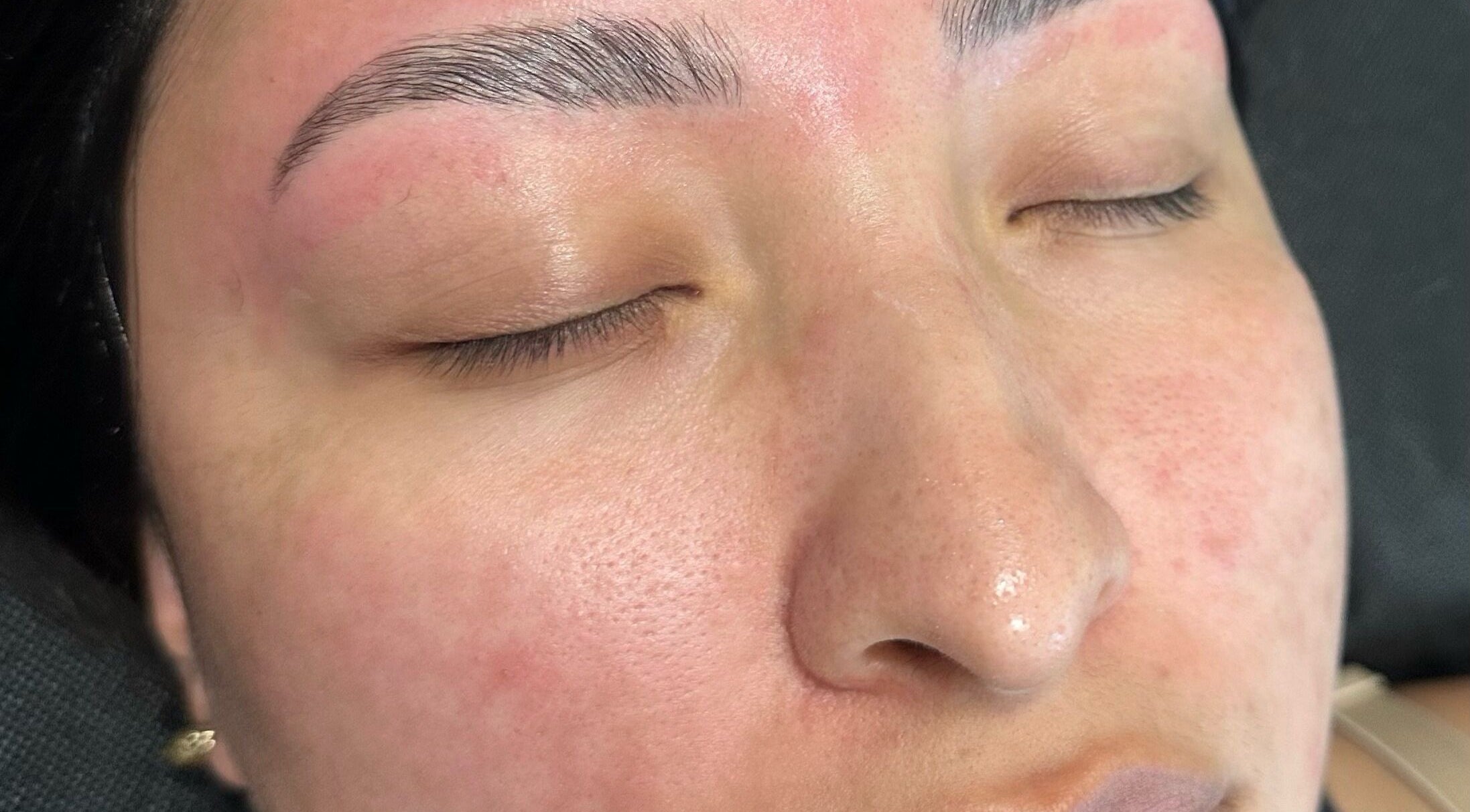 Client post-treatment with smooth skin at Nightshade Esthetics LLC, San Diego, California, US.