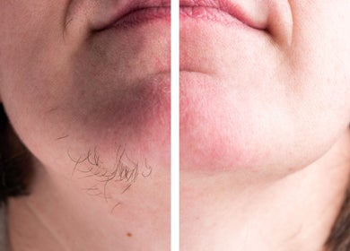 Before and after soft touch electrolysis at Skin Solutions & Soft Touch Electrolysis with Zailey, Mansfield, Ohio, US.