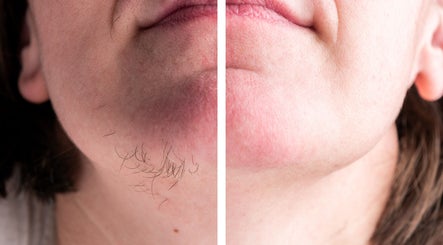 Before and after soft touch electrolysis at Skin Solutions & Soft Touch Electrolysis with Zailey, Mansfield, Ohio, US.