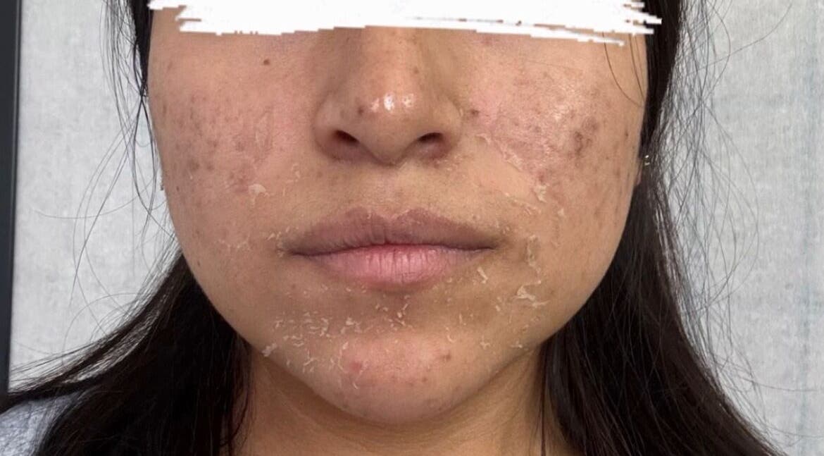 Facial skin peeling treatment at ABY SKIN CARE, New York, New York, US, for acne-prone skin improvement.