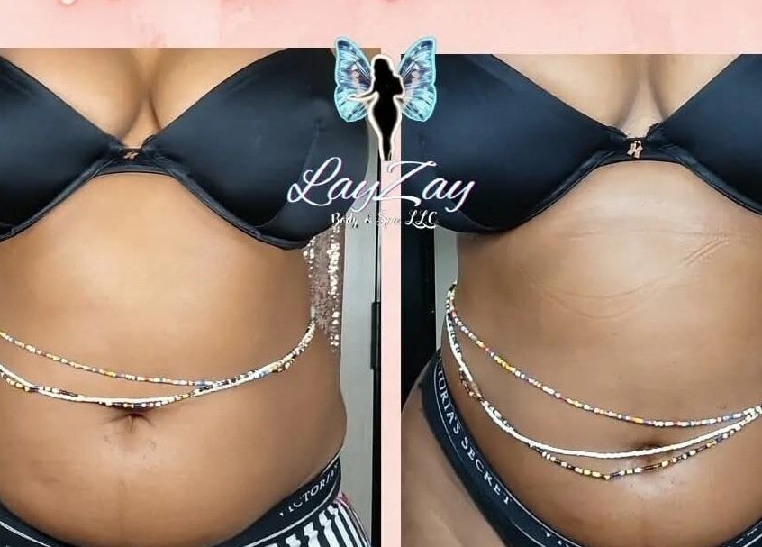 Before and after body contouring at Lay Zay Body and Spa, Garland, Texas, US showcasing significant transformation.