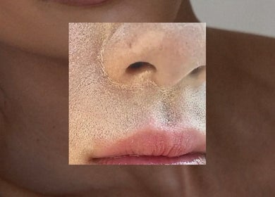 Close-up of exfoliated skin at Dalia Aziz Aesthetics, Verdun, Beirut Governorate, LB.
