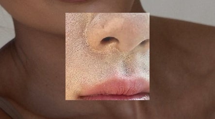 Close-up of exfoliated skin at Dalia Aziz Aesthetics, Verdun, Beirut Governorate, LB.