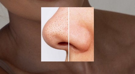 Before and after nose treatment at Dalia Aziz Aesthetics, Verdun, Beirut Governorate, LB