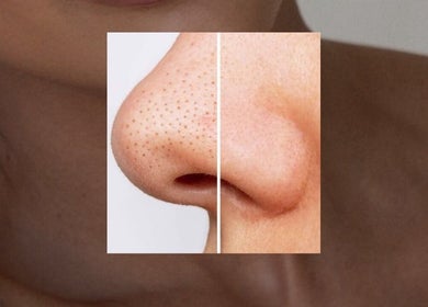 Before and after nose treatment at Dalia Aziz Aesthetics, Verdun, Beirut Governorate, LB.