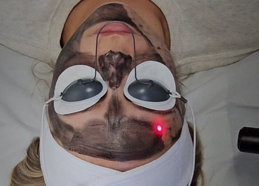 Close-up of laser facial treatment at Signature Laser in Kintore, Scotland, GB.