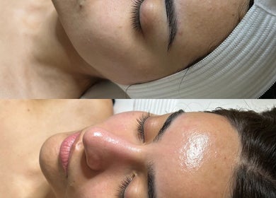 Before and after facial results at Balanced Beauty Med Spa in Vaughan, Ontario, CA showcasing glowing skin.