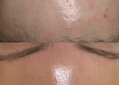 Before and after skin treatment at Balanced Beauty Med Spa in Vaughan, Ontario, CA, showing improved forehead skin.