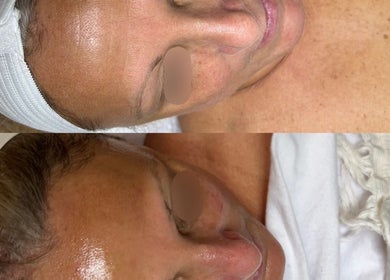 Before and after skin treatment at Balanced Beauty Med Spa, Vaughan, Ontario, CA, showing improved complexion.