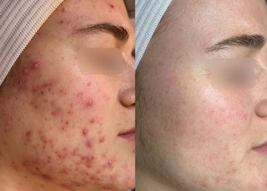 Acne treatment results at Balanced Beauty Med Spa, Vaughan, Ontario, CA. Before and after clear skin transformation.