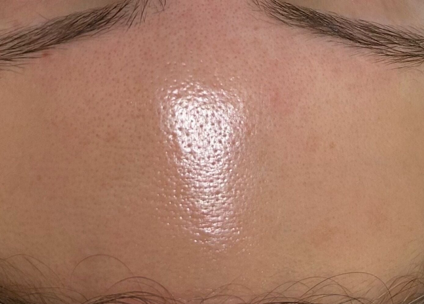 Close-up of a glowing forehead representing skincare at Balanced Beauty Med Spa, Vaughan, Ontario, CA.