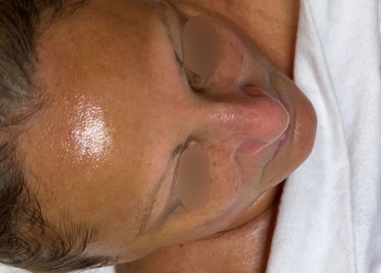 Glowing skin after facial treatment at Balanced Beauty Med Spa in Vaughan, Ontario, CA, showcasing smooth complexion.