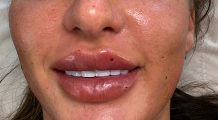 Close-up of enhanced lips after treatment at Honeys Beauty Galore, London, England, GB.