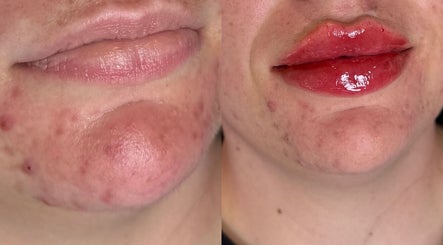 Lip enhancement before and after at Honeys Beauty Galore, London, England, GB.