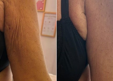 Before and after arm treatment at Michaela's Touch, St Helens, England, GB showcasing improved skin texture.