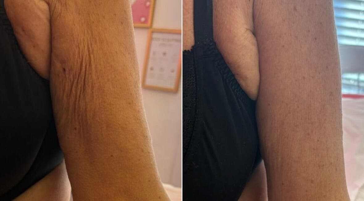 Before and after arm treatment at Michaela's Touch, St Helens, England, GB showcasing improved skin texture.
