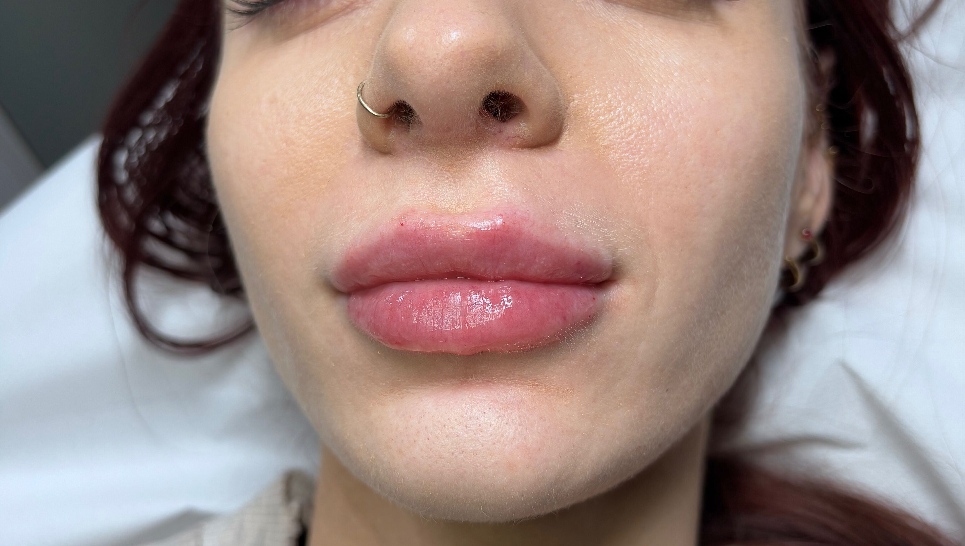 Lip enhancement at Serene Essence Aesthetics in Edinburgh, Scotland, GB showcasing smooth, full lips.