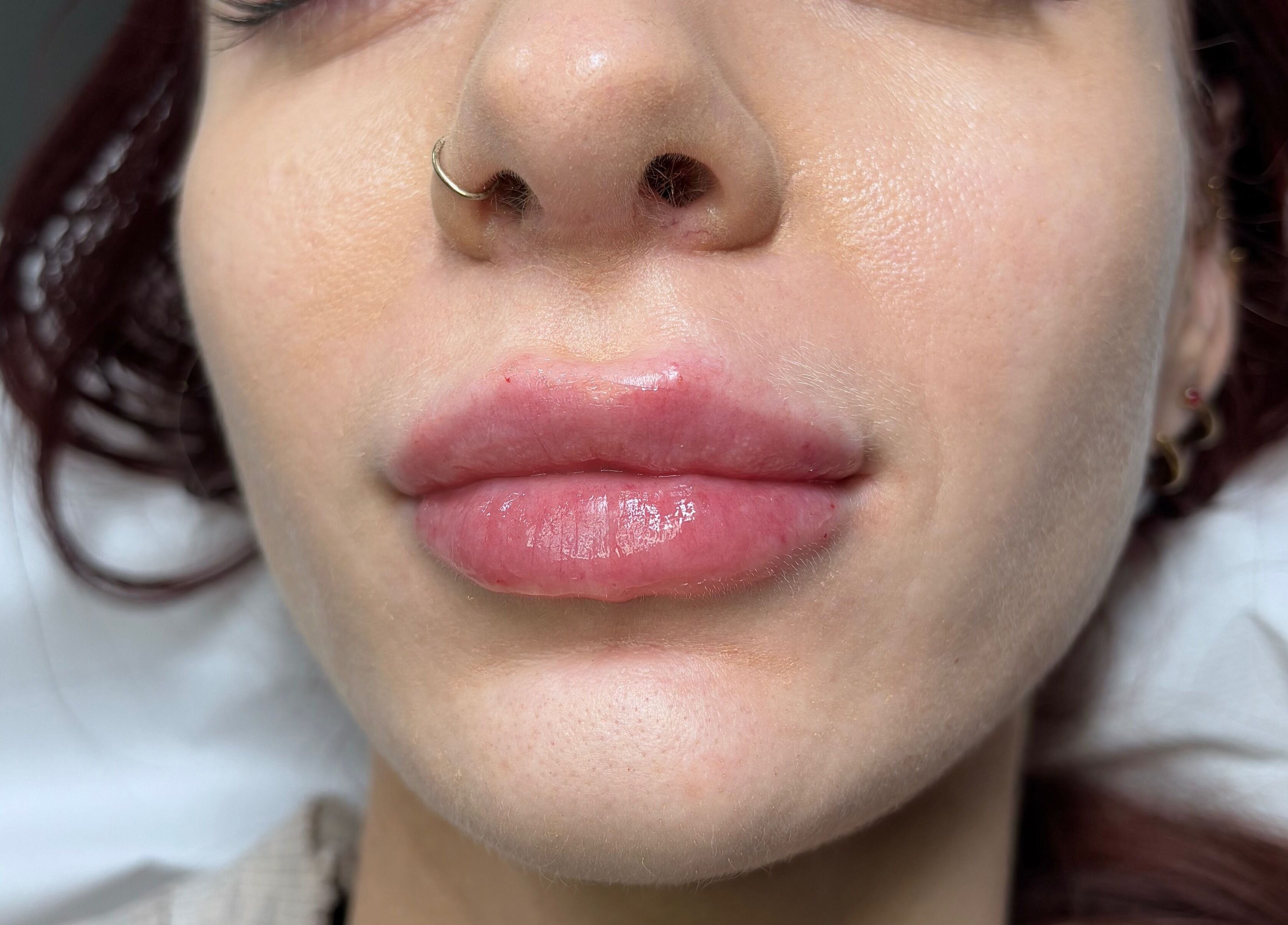 Lip enhancement at Serene Essence Aesthetics in Edinburgh, Scotland, GB showcasing smooth, full lips.
