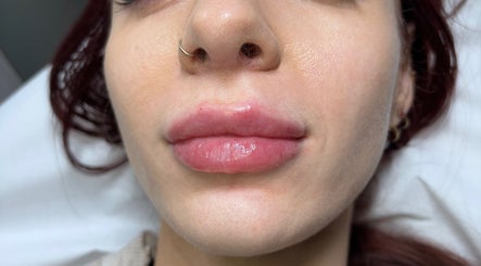 Lip enhancement at Serene Essence Aesthetics in Edinburgh, Scotland, GB showcasing smooth, full lips.