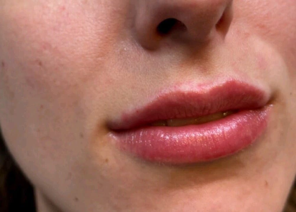 Beautiful lip enhancement at Serene Essence Aesthetics, Edinburgh, Scotland, GB for a radiant look.