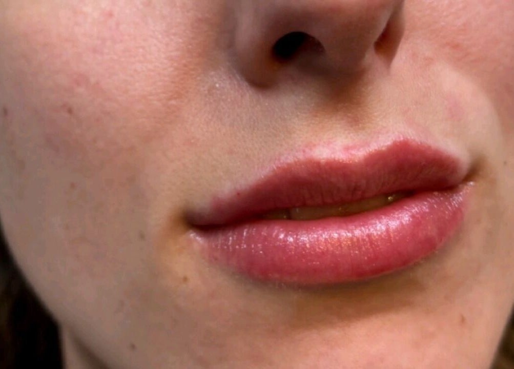 Beautiful lip enhancement at Serene Essence Aesthetics, Edinburgh, Scotland, GB for a radiant look.