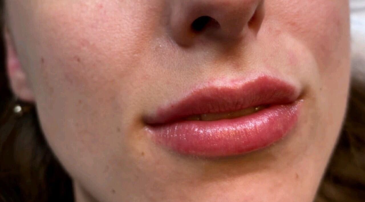 Beautiful lip enhancement at Serene Essence Aesthetics, Edinburgh, Scotland, GB for a radiant look.