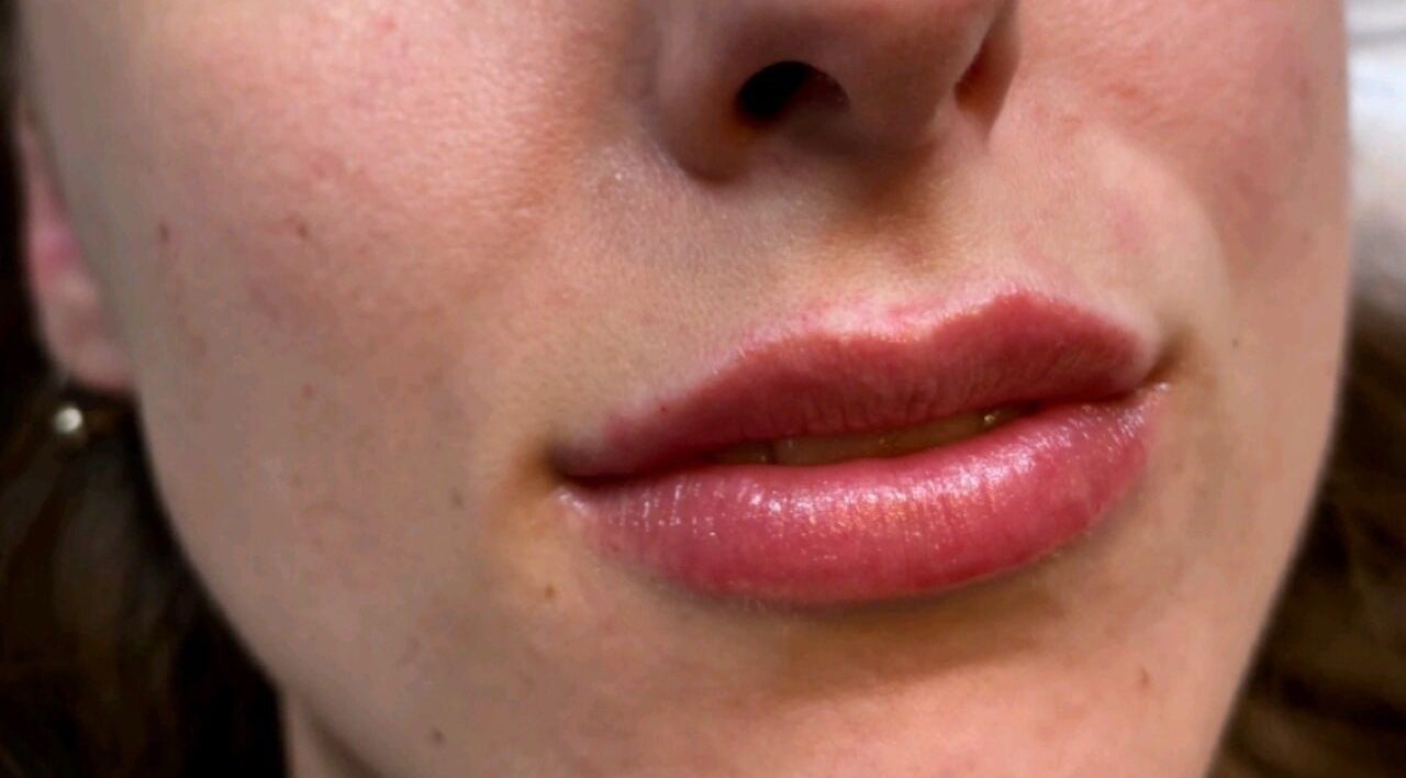 Beautiful lip enhancement at Serene Essence Aesthetics, Edinburgh, Scotland, GB for a radiant look.