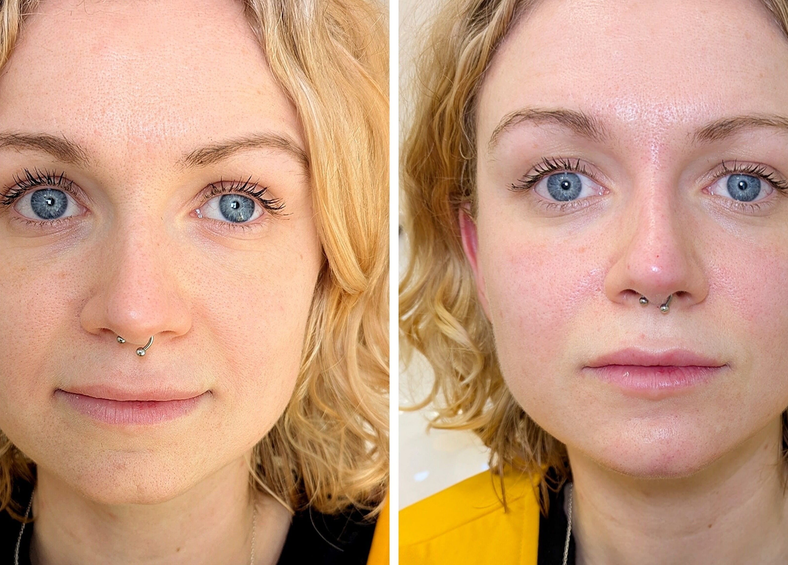 Before and after skincare results at Mona Aesthetics, Leeds, England, GB, highlighting facial rejuvenation.
