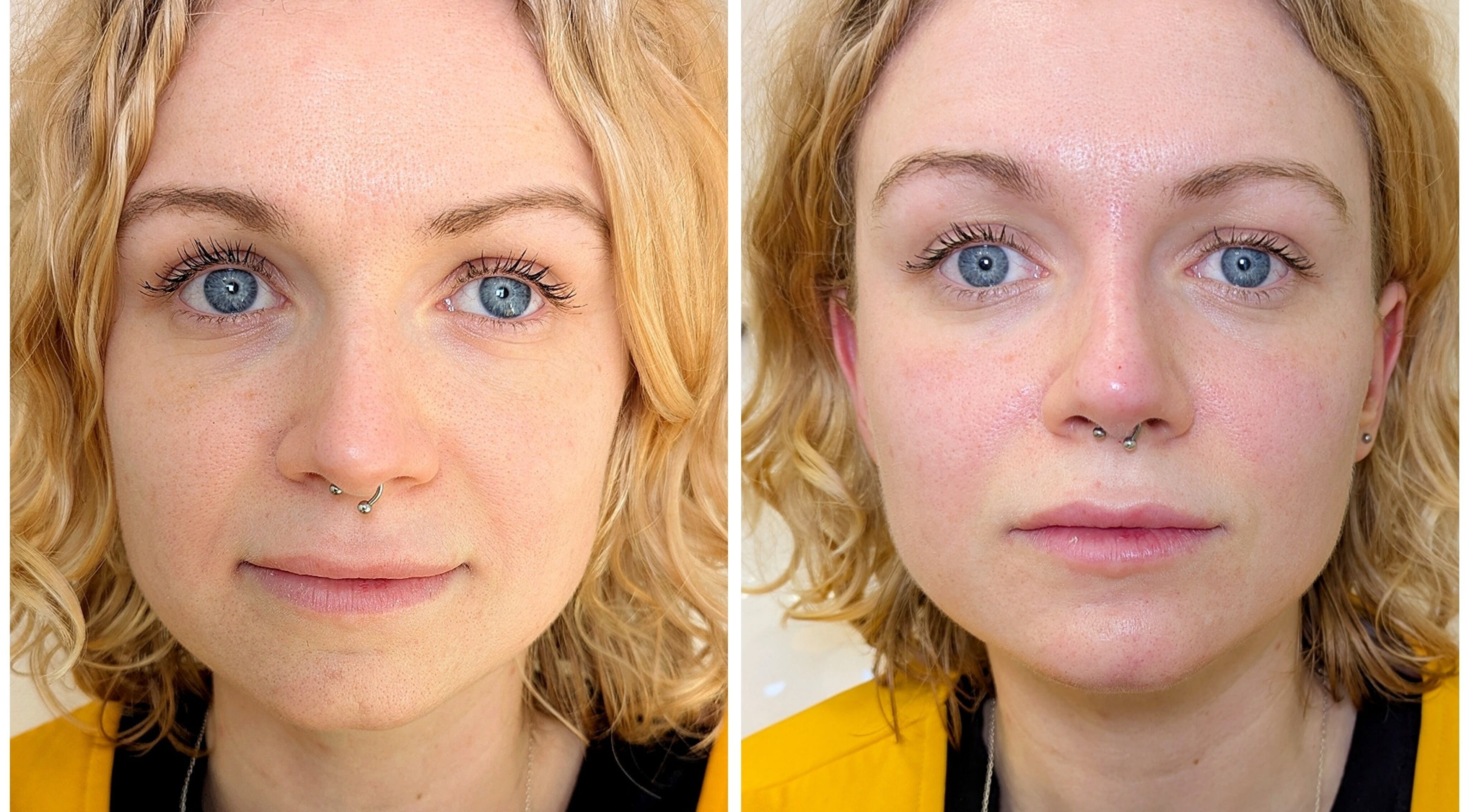Before and after skincare results at Mona Aesthetics, Leeds, England, GB, highlighting facial rejuvenation.