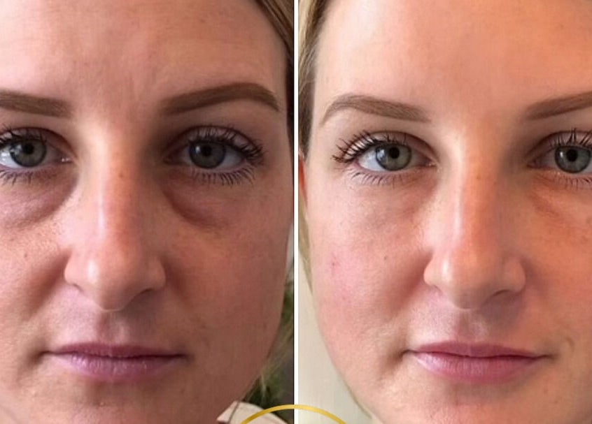Before and after facial transformation at Mona Aesthetics, Leeds, England, GB, showcasing remarkable skin improvement.