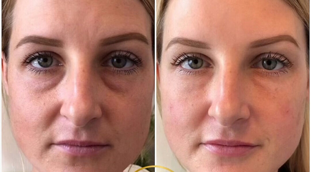 Before and after facial transformation at Mona Aesthetics, Leeds, England, GB, showcasing remarkable skin improvement.