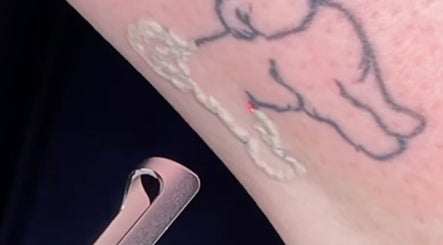 Brighton Tattoo Removal image 2