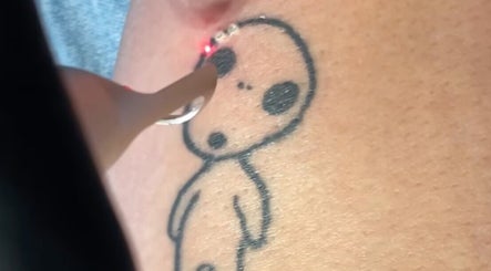 Brighton Tattoo Removal image 3