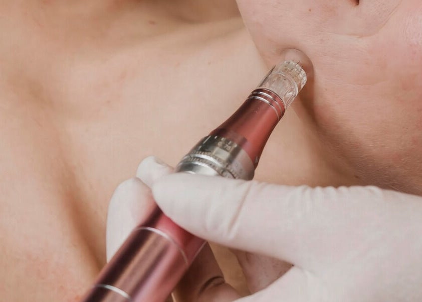 Microneedling facial at LymphLondon by Bruna Milioli | Home Service in London, England, GB.