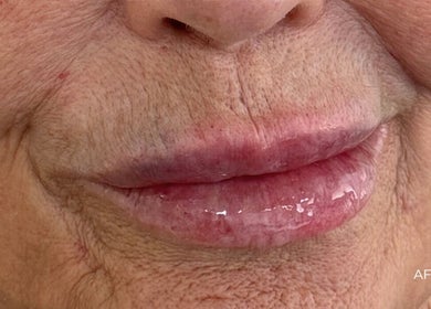 Lip enhancement results at Nūse Aesthetics in Nottingham, England, GB showcasing improved fullness.