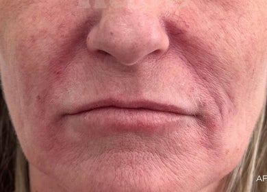 Nūse Aesthetics smooth skin treatment result in Nottingham, England, GB.