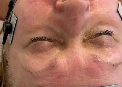 Facial treatment at Look Like A Million Dollars, London, England, GB with advanced beauty technology for skin revitalization.