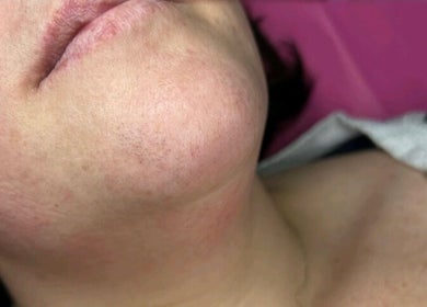 Close-up of chin area at Ep Laser Clinic Shrewsbury, showcasing skin texture in Shrewsbury, England, GB.