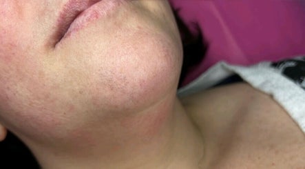 Close-up of chin area at Ep Laser Clinic Shrewsbury, showcasing skin texture in Shrewsbury, England, GB.